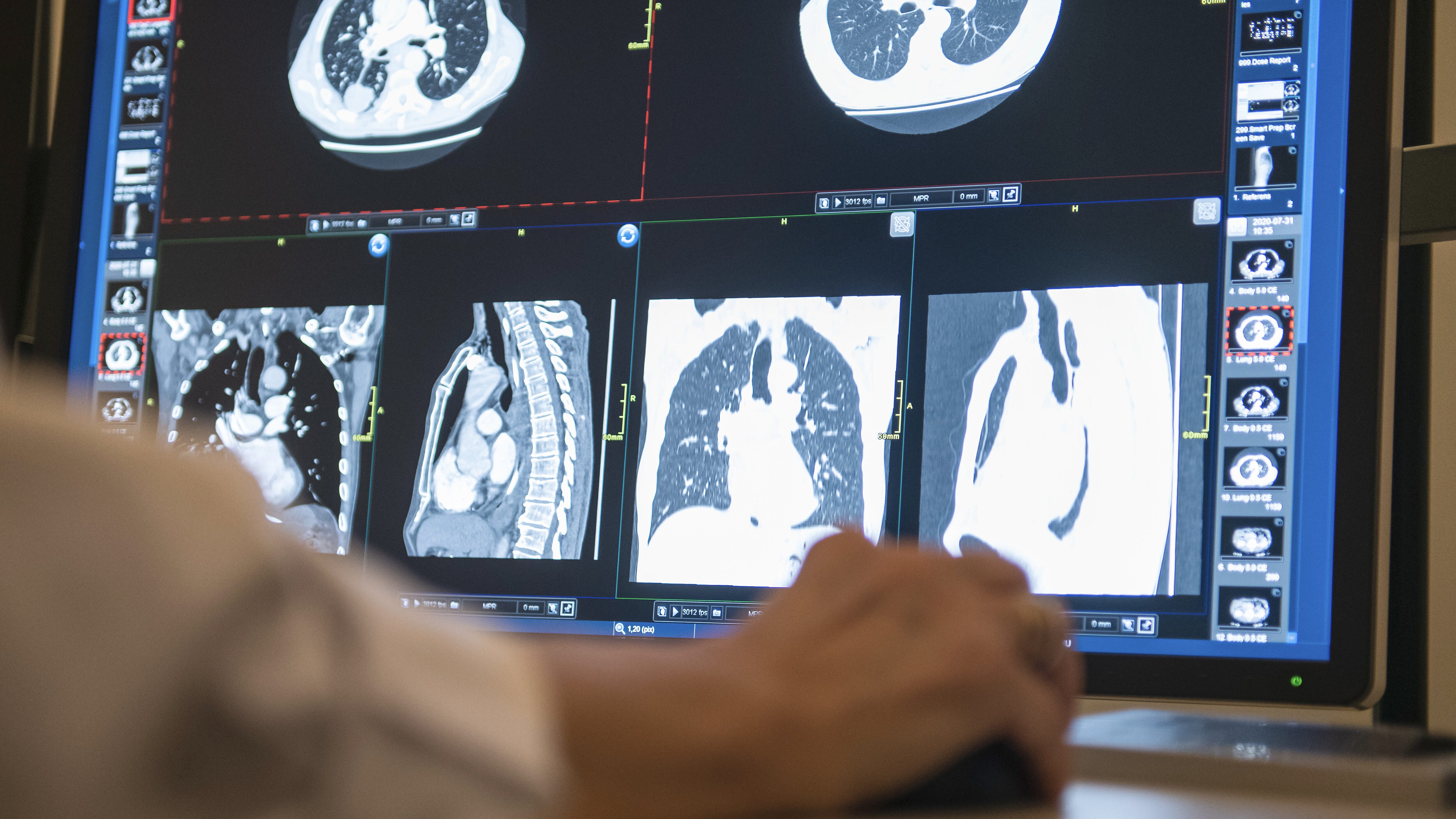 Lungskador bekräftade bland långtidssjuka i covid-19 - Dagens Medicin