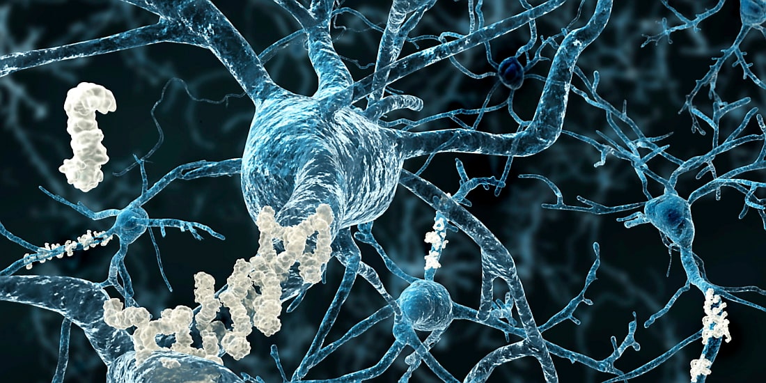 Positiva Resultat För Antikropp Mot Alzheimer Dagens Medicin 